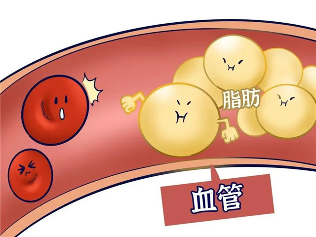 高血脂丨心血管疾病幕后黑手