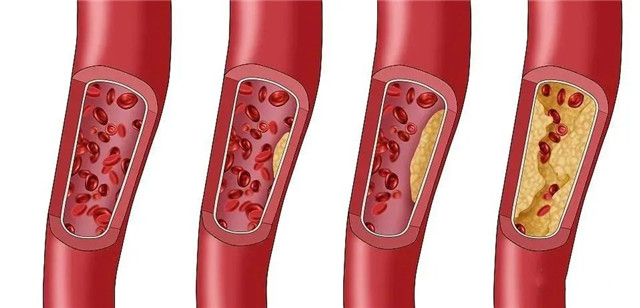 干细胞帮助改善高血脂，有效防止并发症